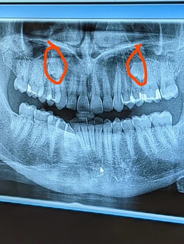 x-ray with circles around the extra teeth