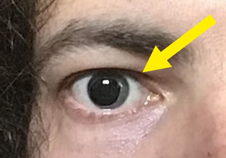 arrow pointing to the dilated pupil
