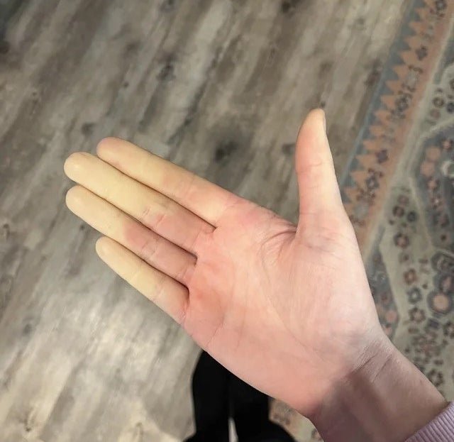 finger tips white while the rest of the hand is red