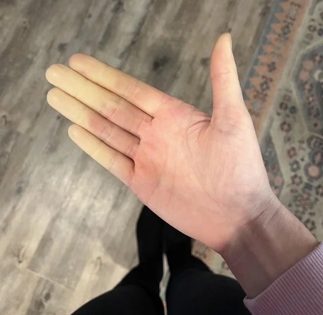 finger tips white while the rest of the hand is red