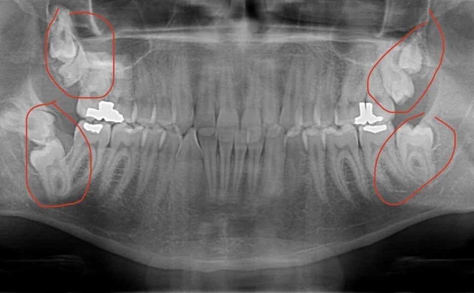 x-ray with circles around all the teeth