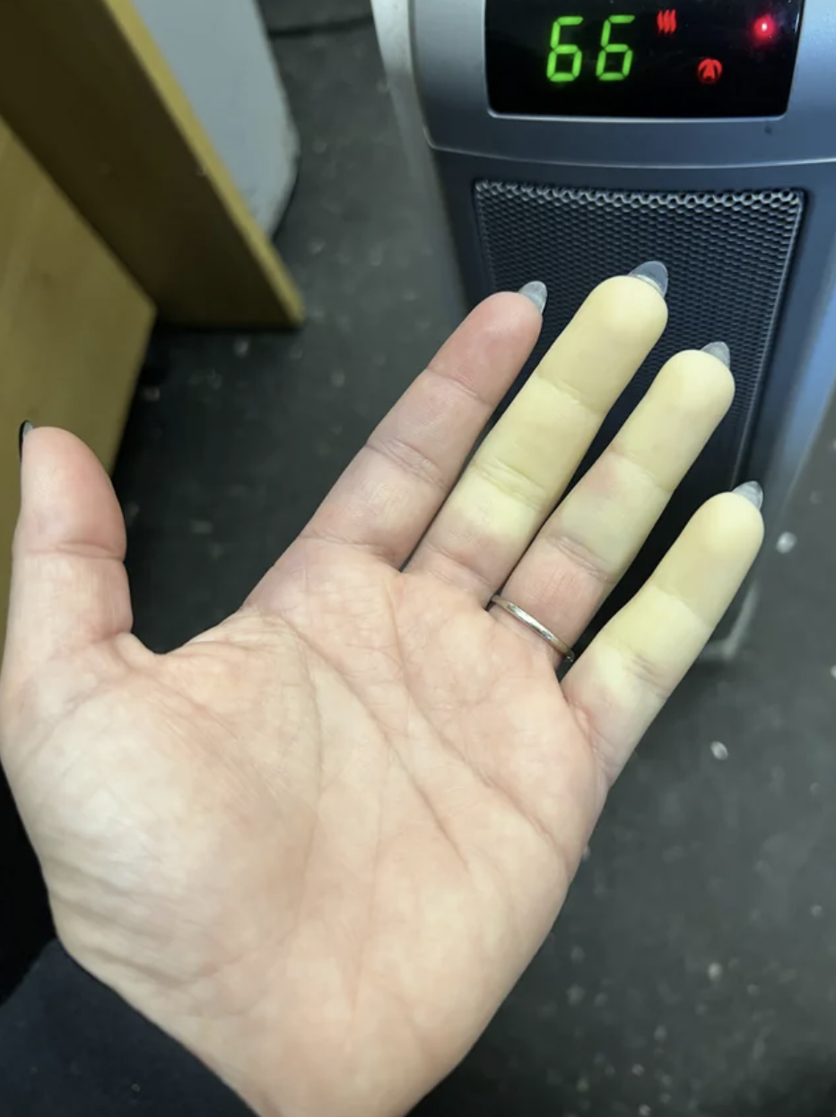 Raynaud’s Syndrome on someone&#x27;s hand