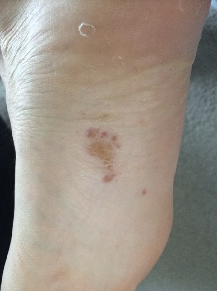 A blister in the shape of a foot