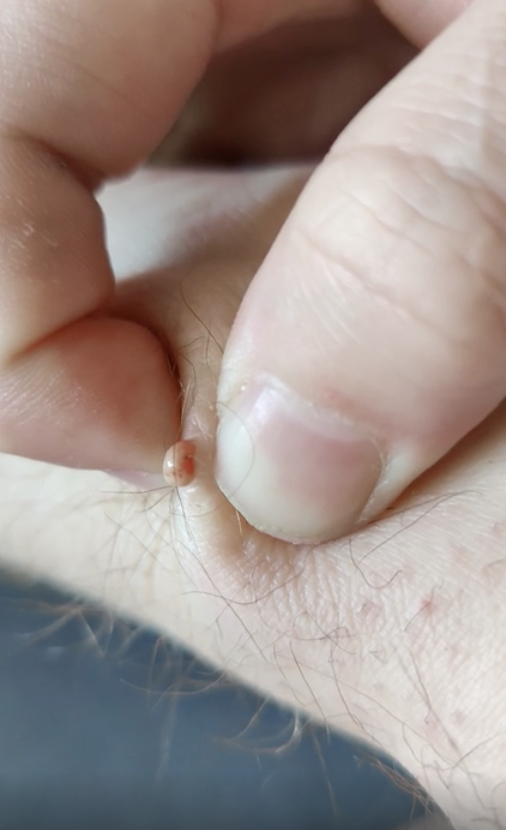 Someone squeezing an ingrown hair