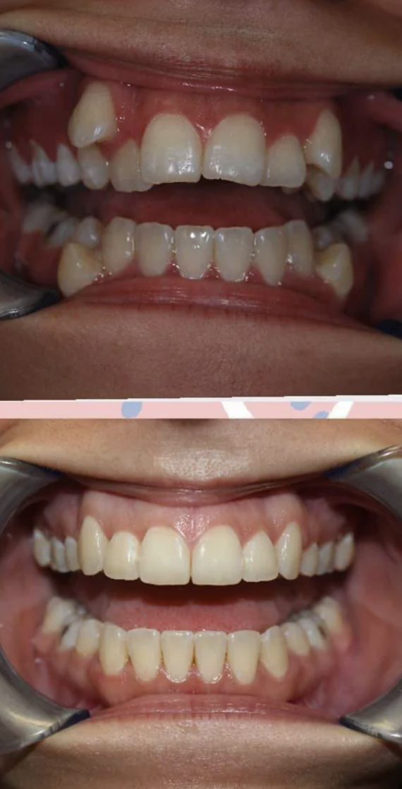 Closeup of someone&#x27;s teeth before and after braces