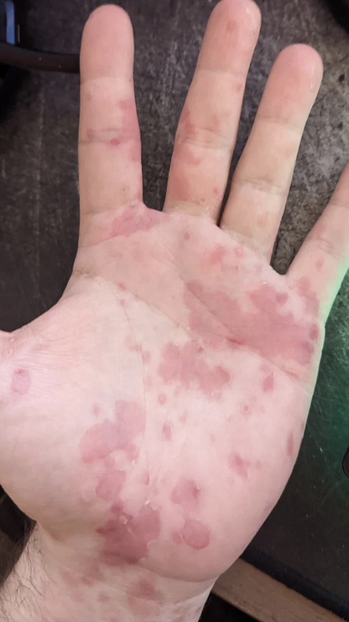A rash on someone&#x27;s hand