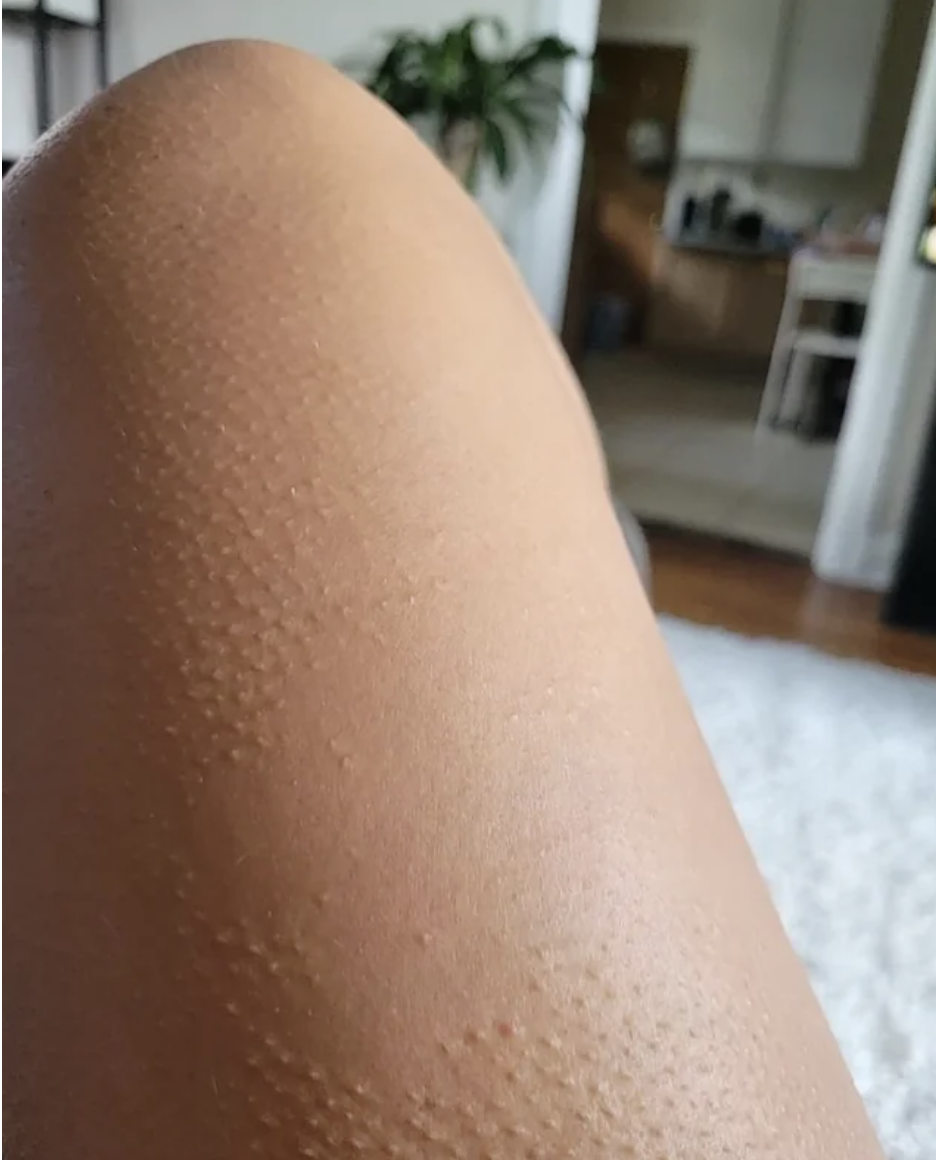 Someone with goosebumps on their leg