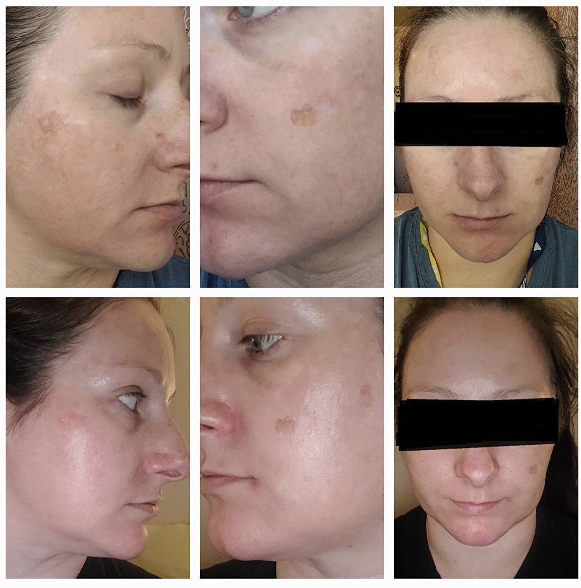 reviewer photo showing their skin before and after using the liquid exfoliant, greatly reducing their dark spots