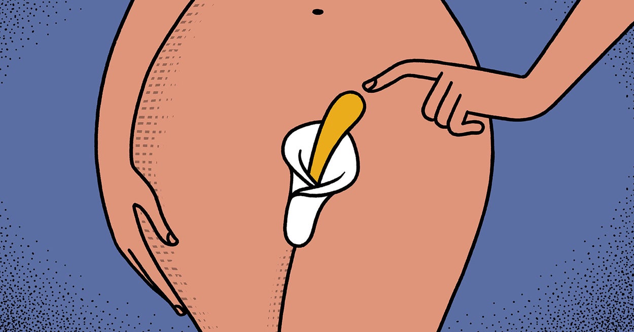 La chirurgie d’élargissement du clitoris se développe