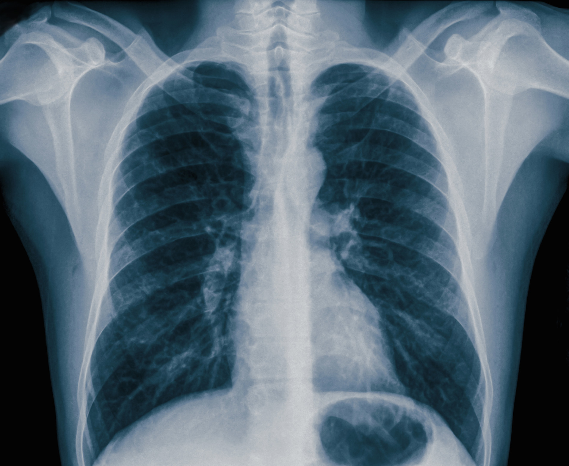 X-ray of a person&#x27;s abdomen