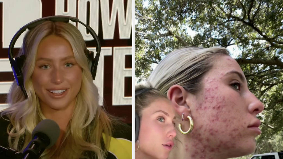 Alix Earle Talks Cystic Acne On Howard Stern