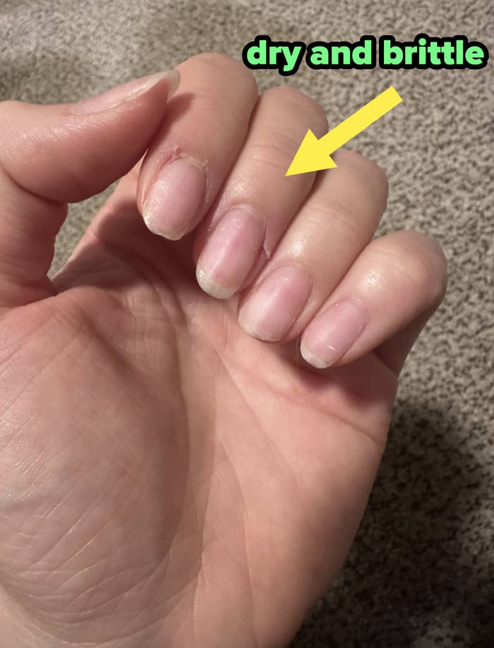 a picture of the author&#x27;s dry and brittle nails
