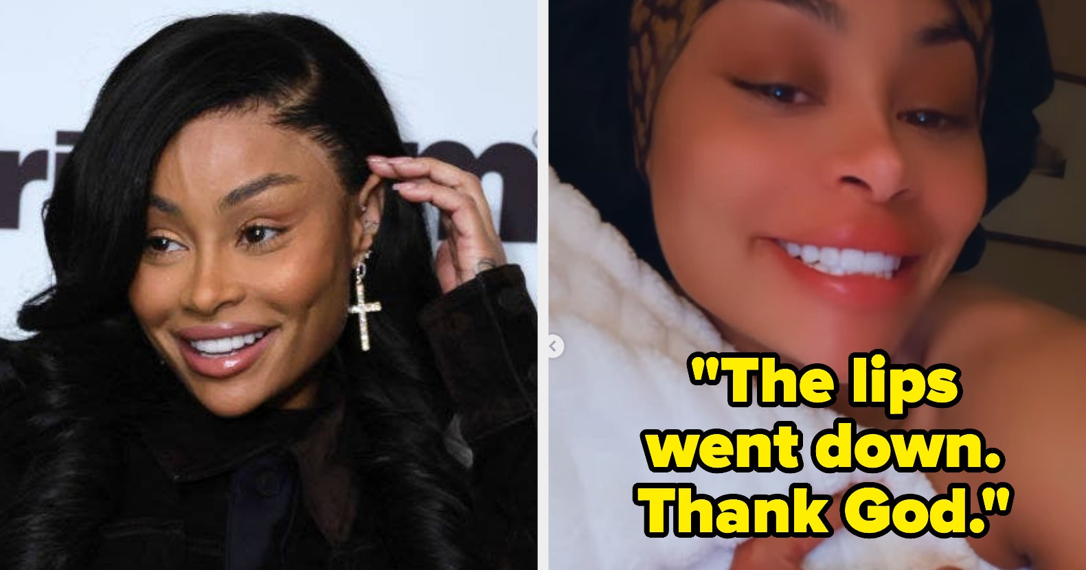 Blac Chyna shows off chiseled cheekbones after removing filler