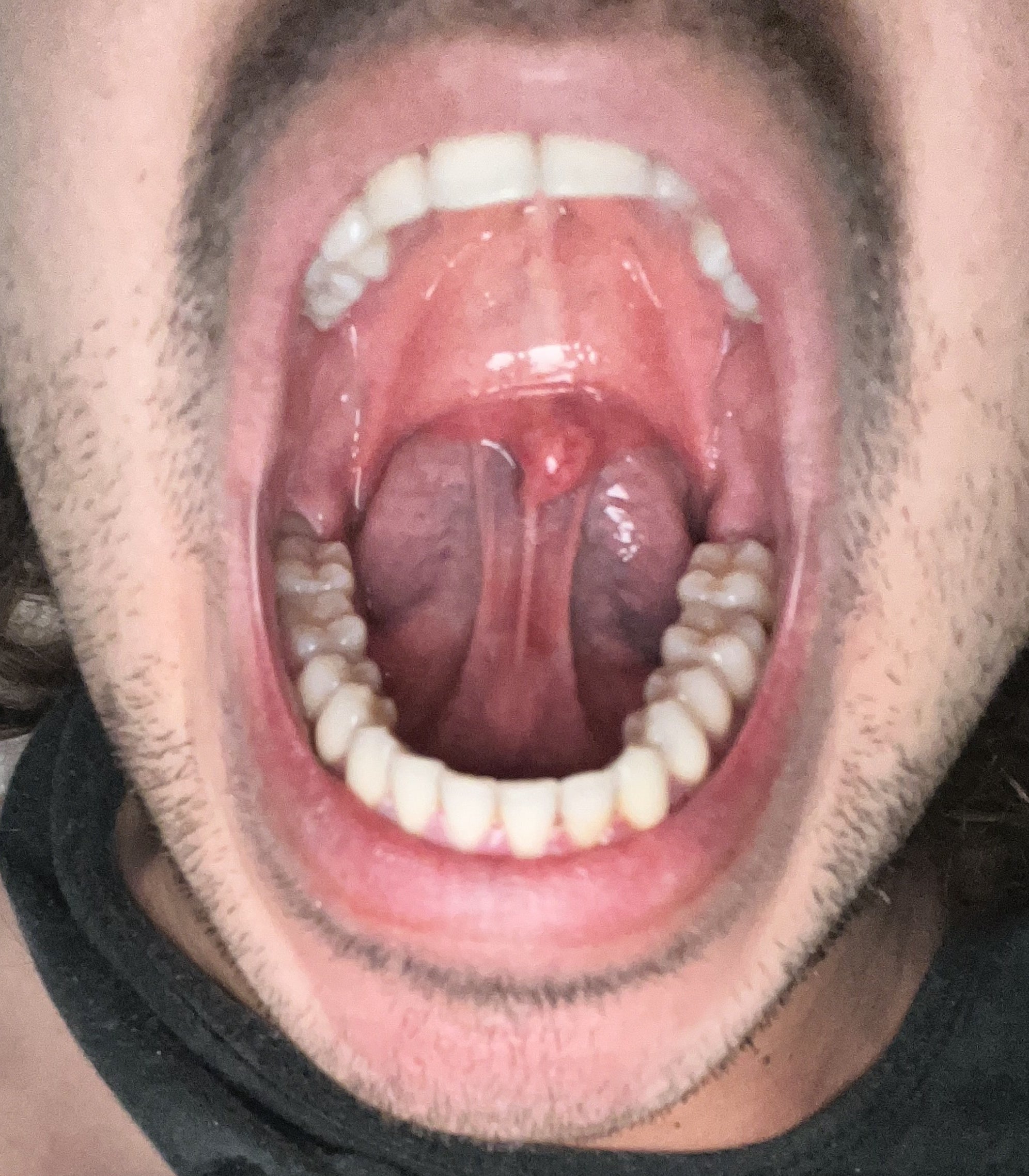 Close-up of a person&#x27;s open mouth showing teeth and uvula, showing the tongue behind the uvula