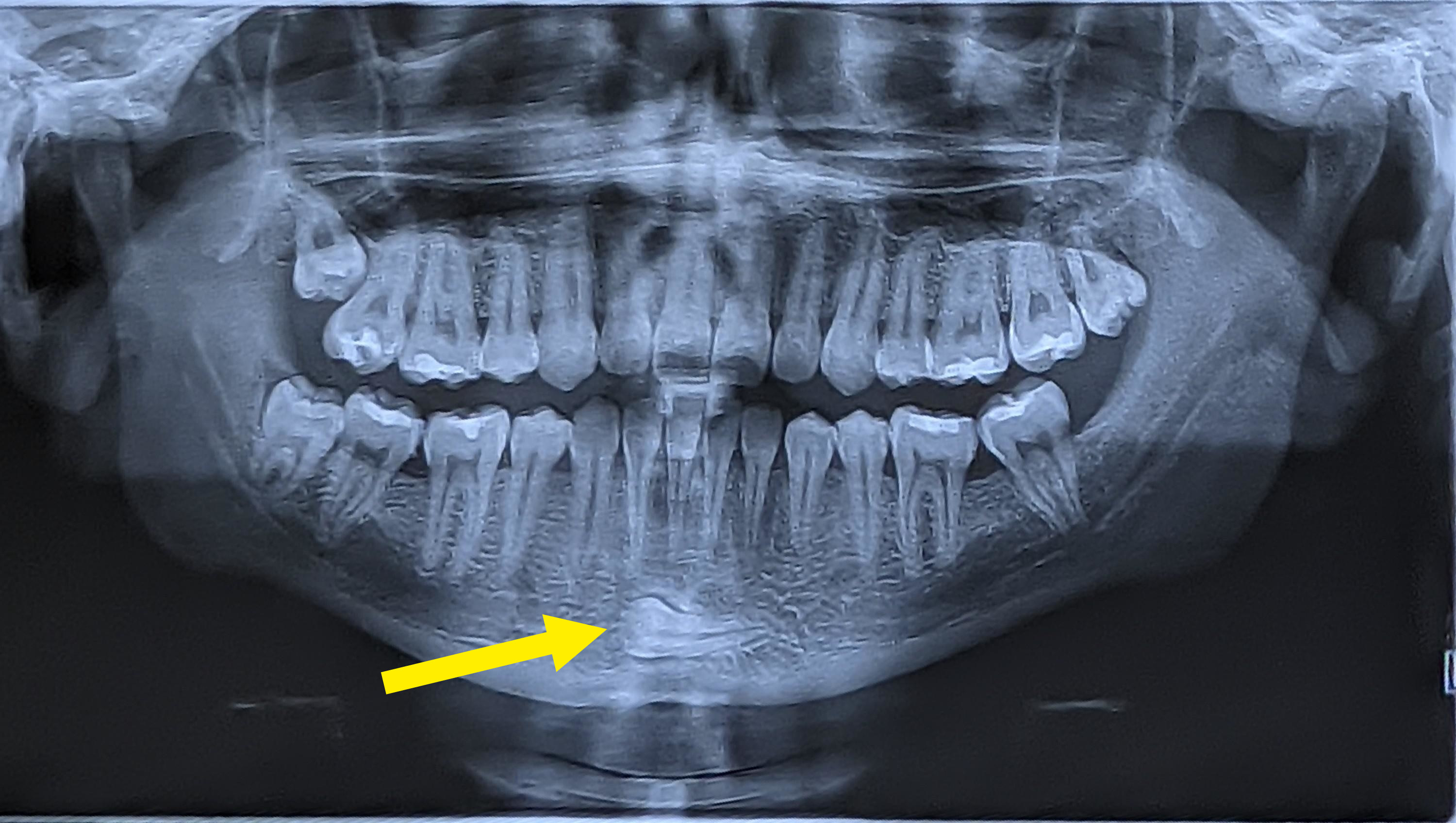 xray photo showing a tooth in a chin