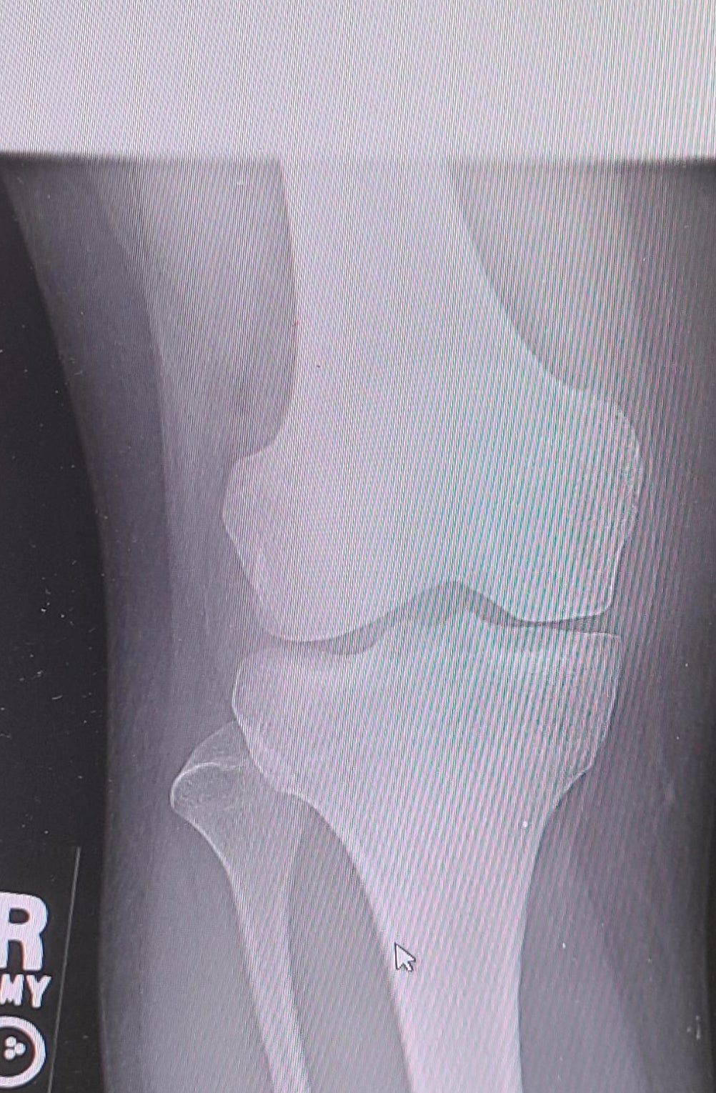 X-ray of a human knee joint with cursor arrow pointing to the area between femur and tibia
