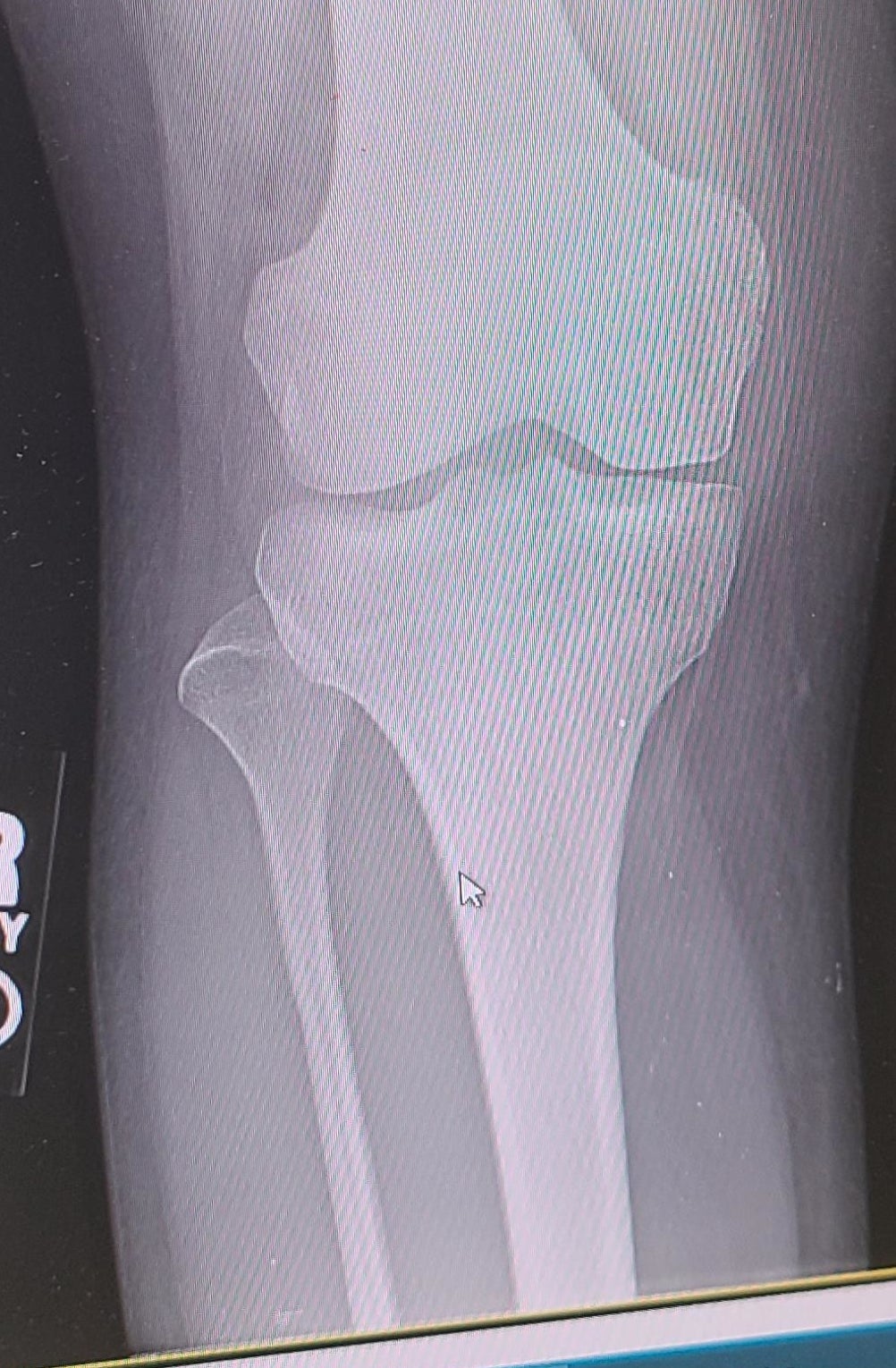 X-ray of a human knee joint with cursor arrow pointing to the area between femur and tibia