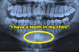 xray of a tooth in someone's chin