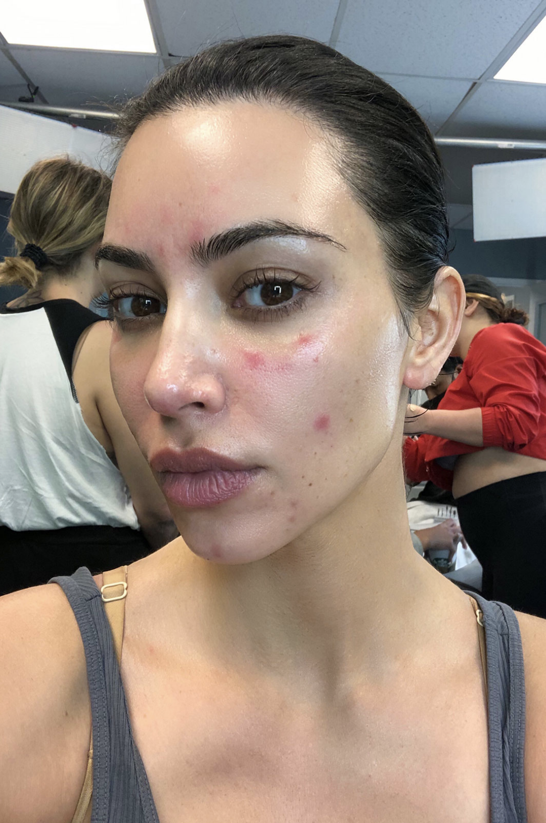 Close-up of Kim with discoloration on her face