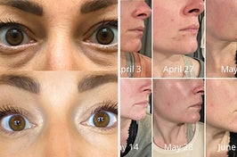 a reviewer showing a before and after of a concealer and a reviewer showing their skin before and after