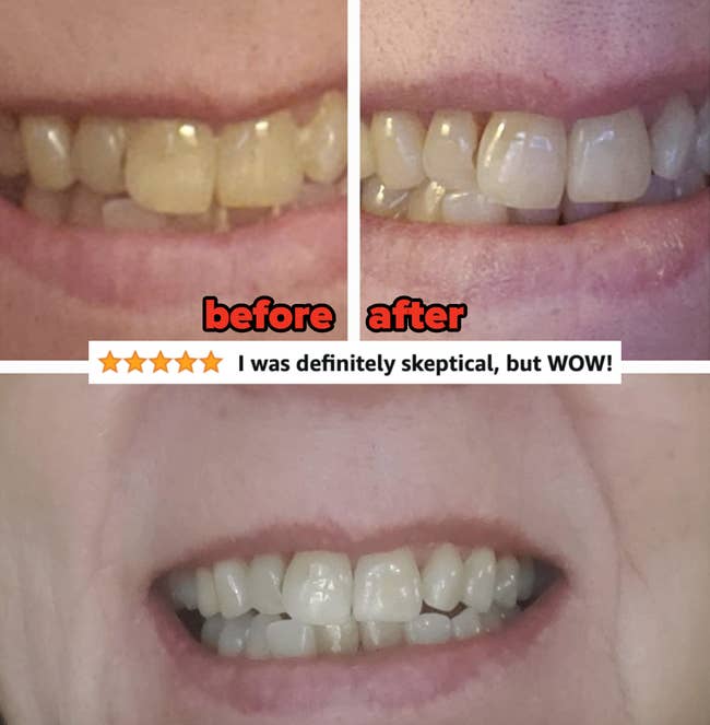 a reviewer's teeth before slightly yellow and after much whiter 