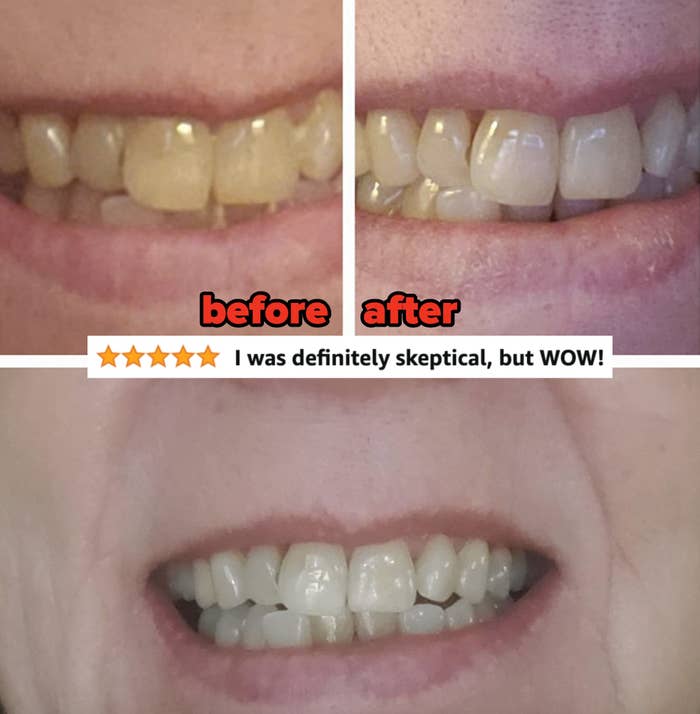 a reviewer&#x27;s teeth before slightly yellow and after much whiter &quot;I was definitely skeptical, but WOW&quot;