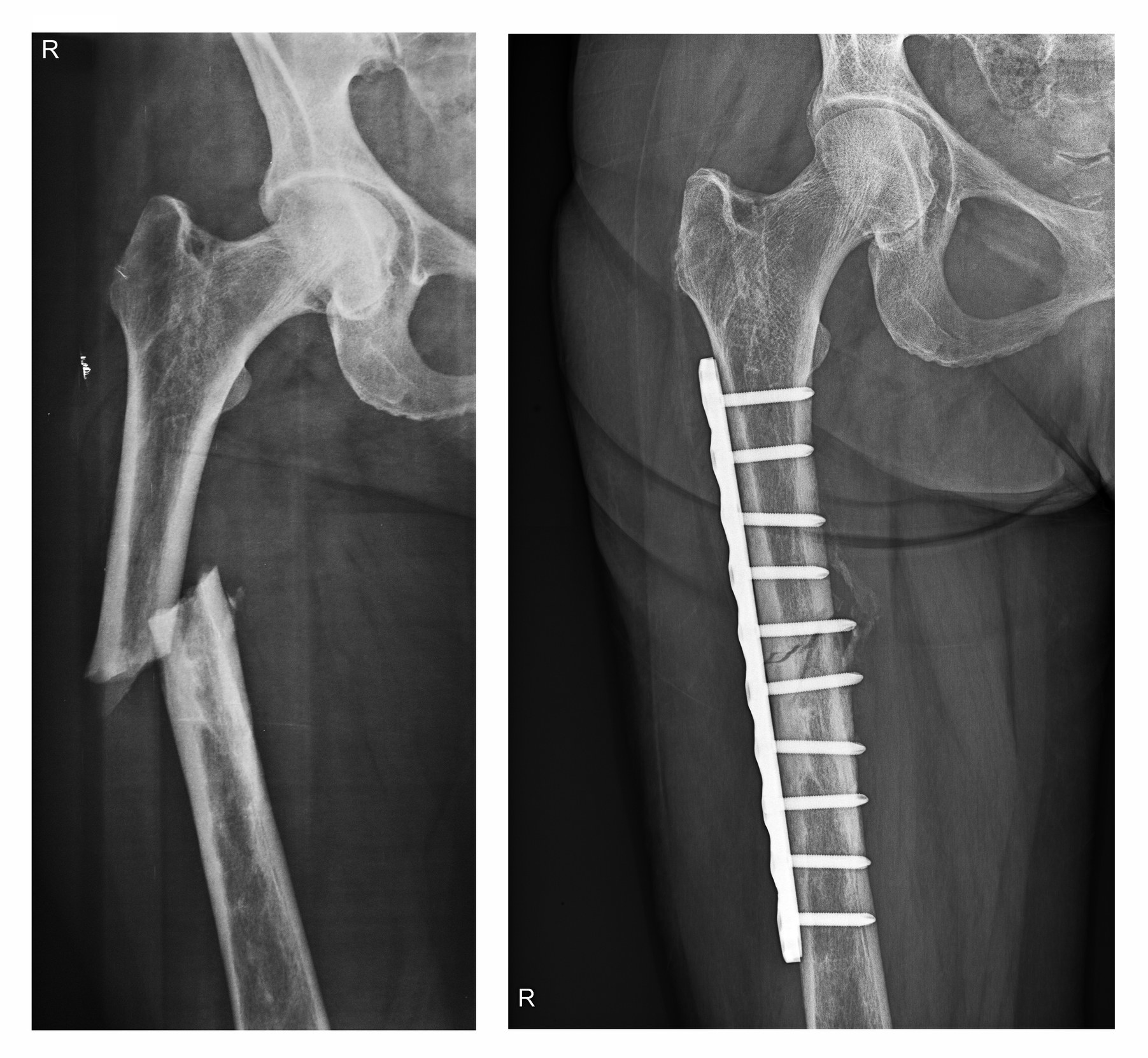 X-rays of broken thigh bone
