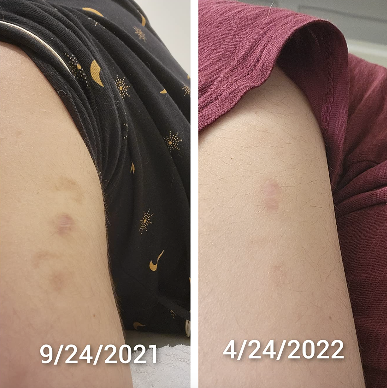 reviewer with dark scars on their arm before and after with them significantly faded