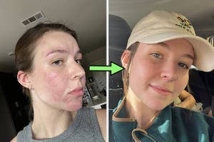 reviewer before and after using the snail mucin with a clearer complexion in the after