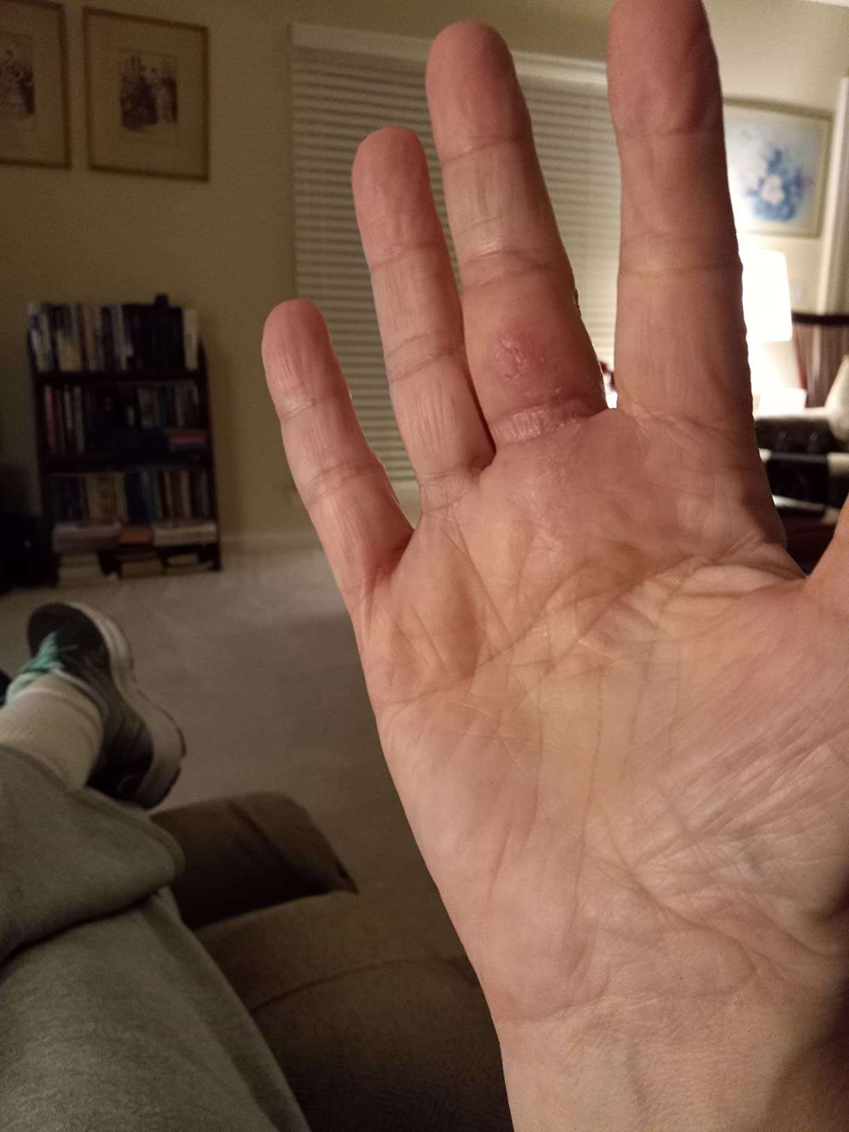 a reviewer&#x27;s hand with a healing incision after using the gel