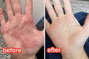 L: a reviewer photo of eczema on their palm labeled "before", R: the same reviewer's hand now cleared up labeled "after"