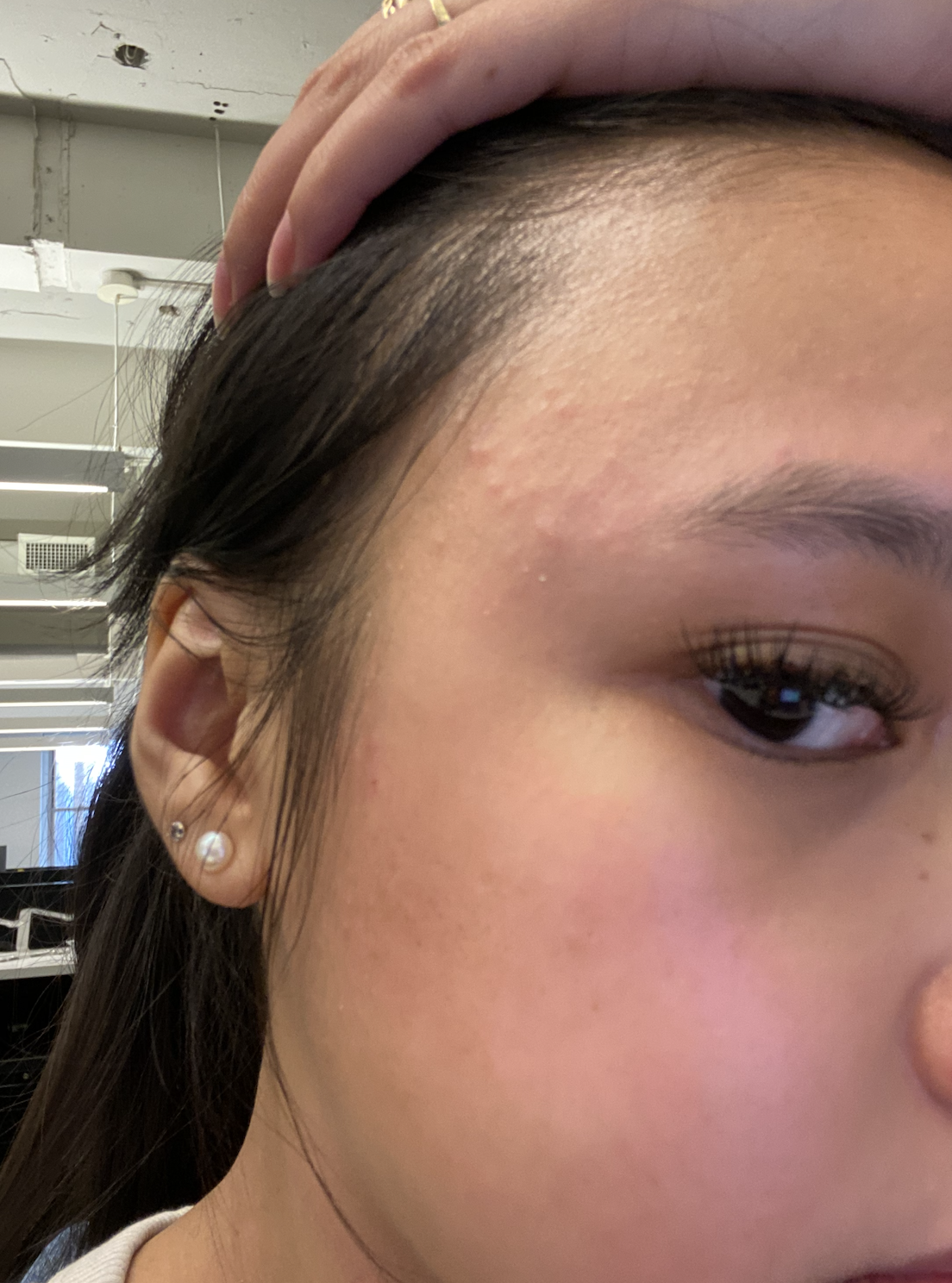 close up of forehead with irritation rash