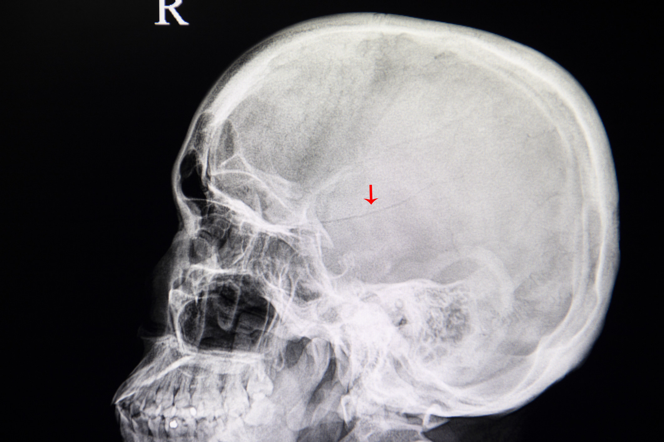 X-ray of a skull fracture