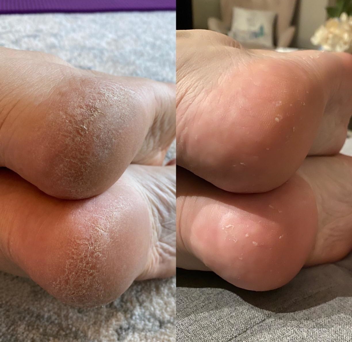 a before and after with the peel