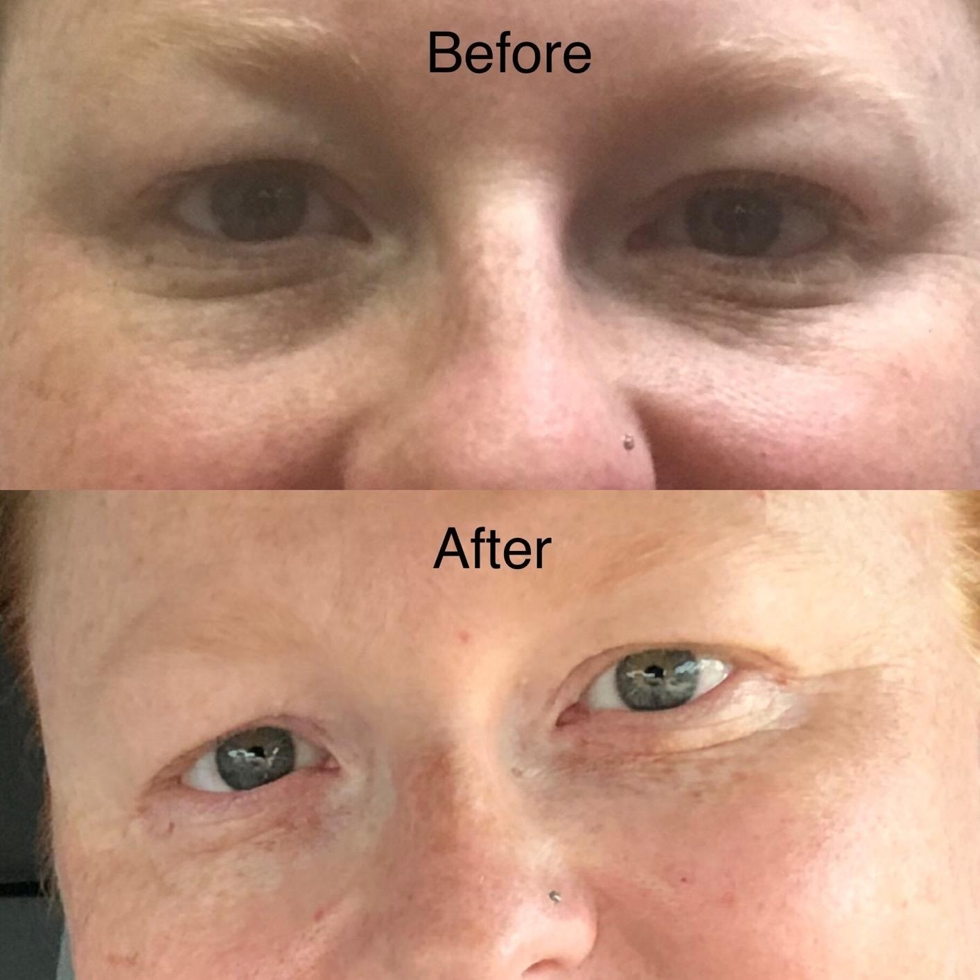 reviewer before photo with bags under their eyes and after photo with tighter skin