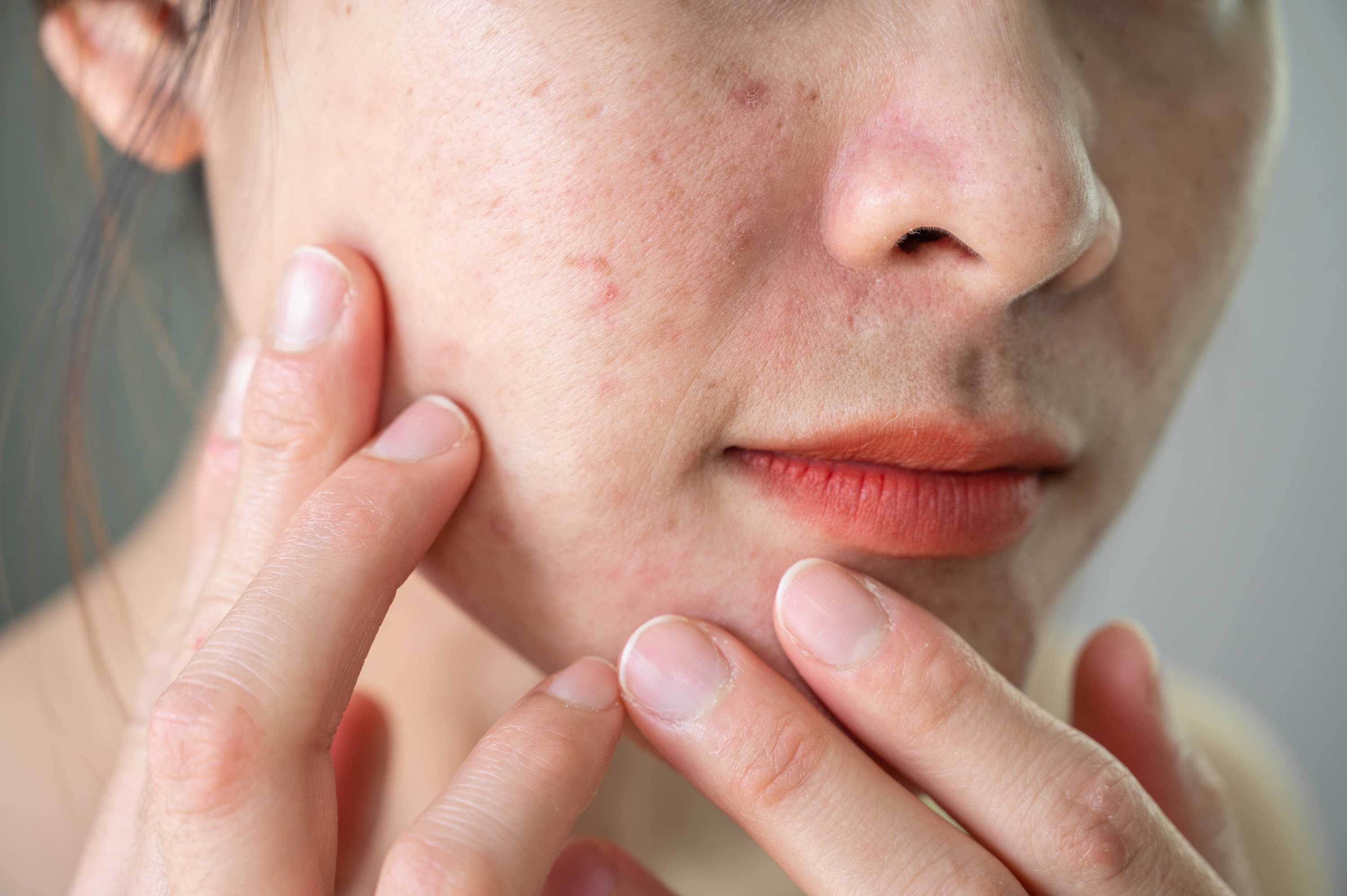 a close-up of acne