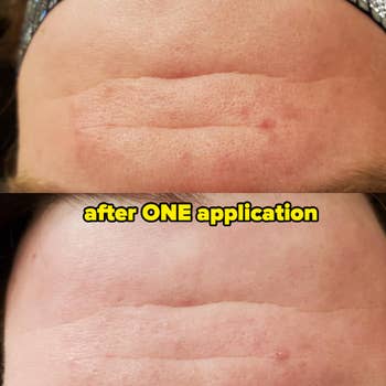 before/after of a reviewer's forehead after 1 application, looking smoother and clearer with reduced pore visibility