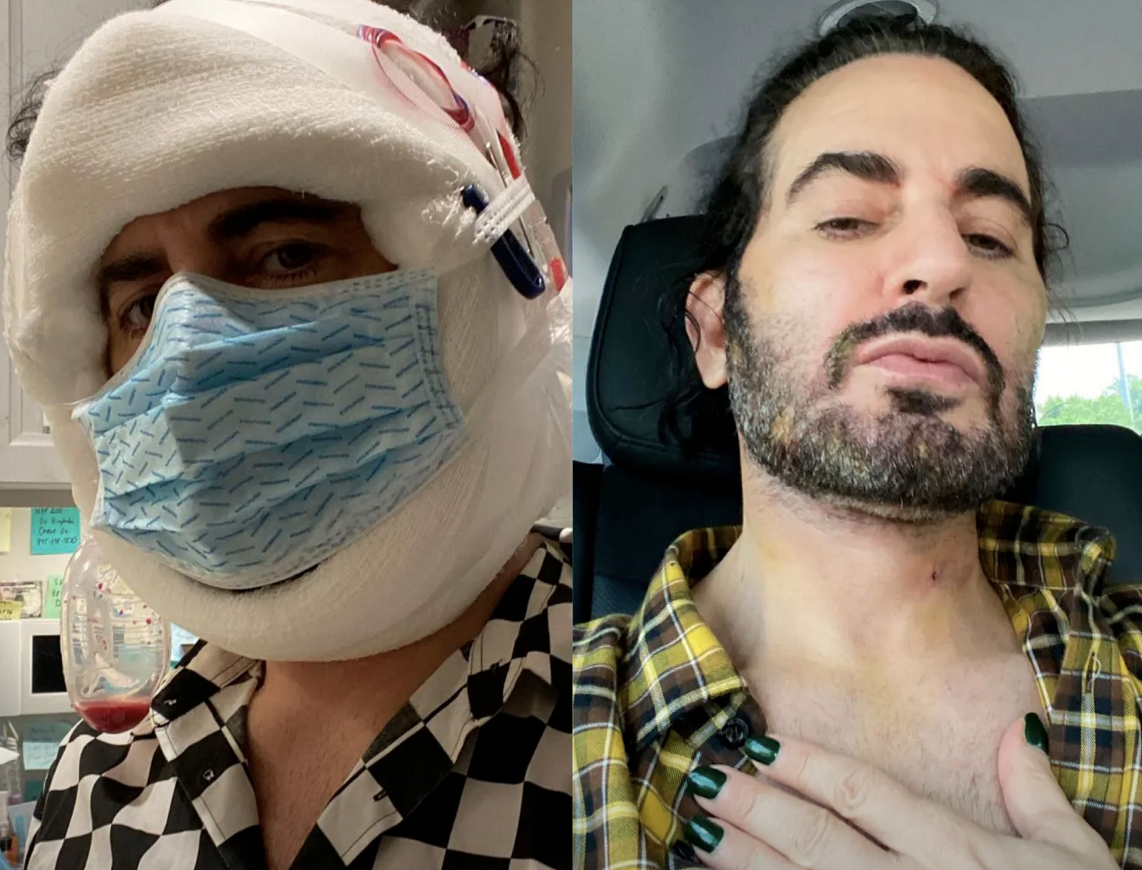 side by side of marc fresh out of surgery with bandages around his head and wearing a face mask and then out of the bandages with his new face