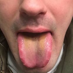 before of a reviewer's tongue with yellow gunk on it