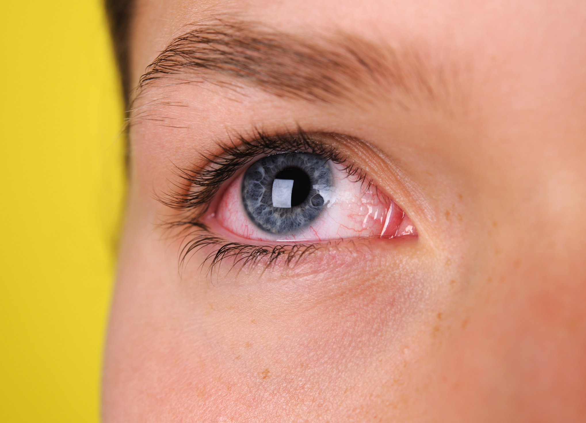 Closeup of an irritated eye