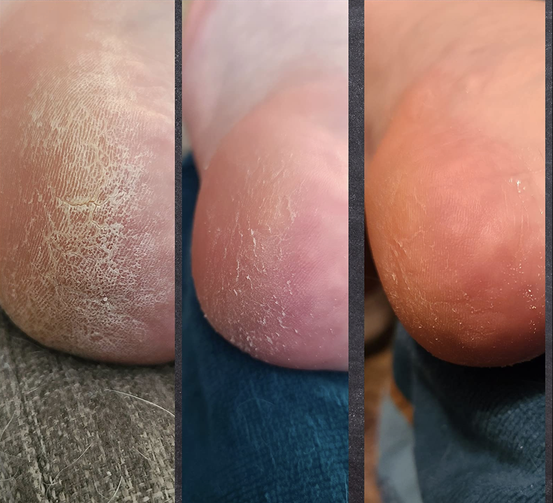 a reviewers before and after of the callus cream