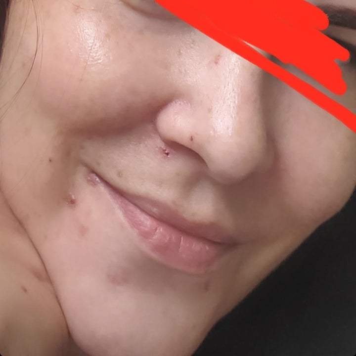 reviewer's skin with blemishes before using the product