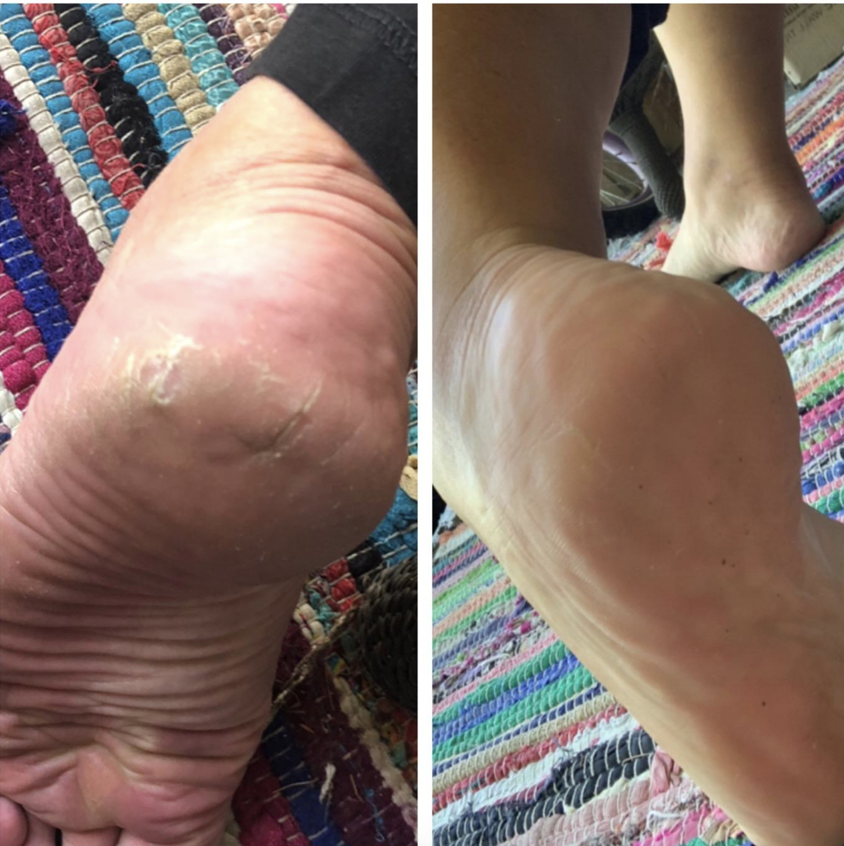 a before and after of the foot cream