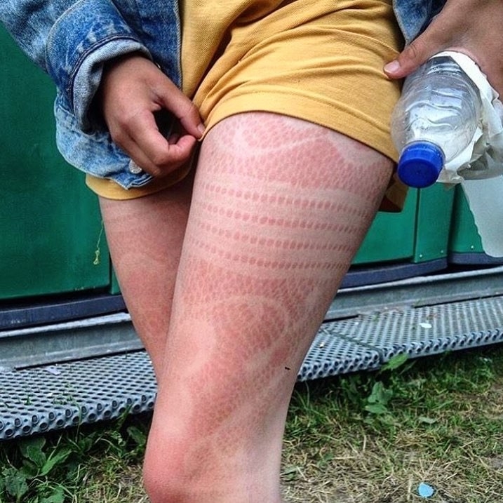 Someone&#x27;s bad sunburn on their legs