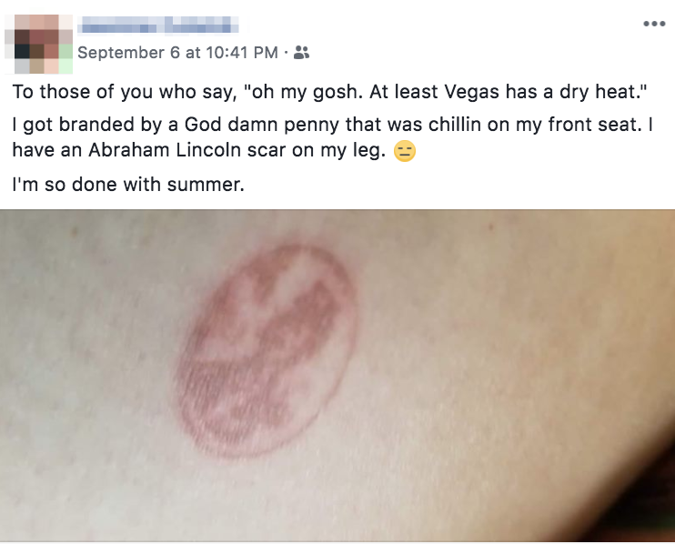 Burn of a penny on someone&#x27;s leg
