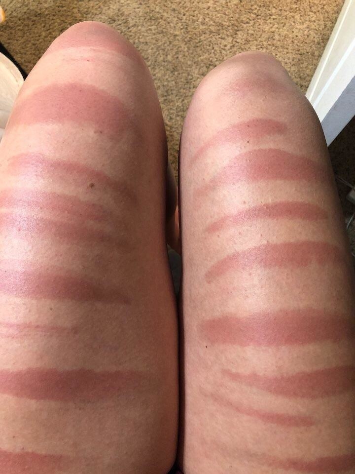 Sunburn on someone&#x27;s thighs