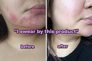 Reviewer with rash and breakout all over their jaw and chin labeled before, and after with clear, breakout-free skin with words "I swear by this product"