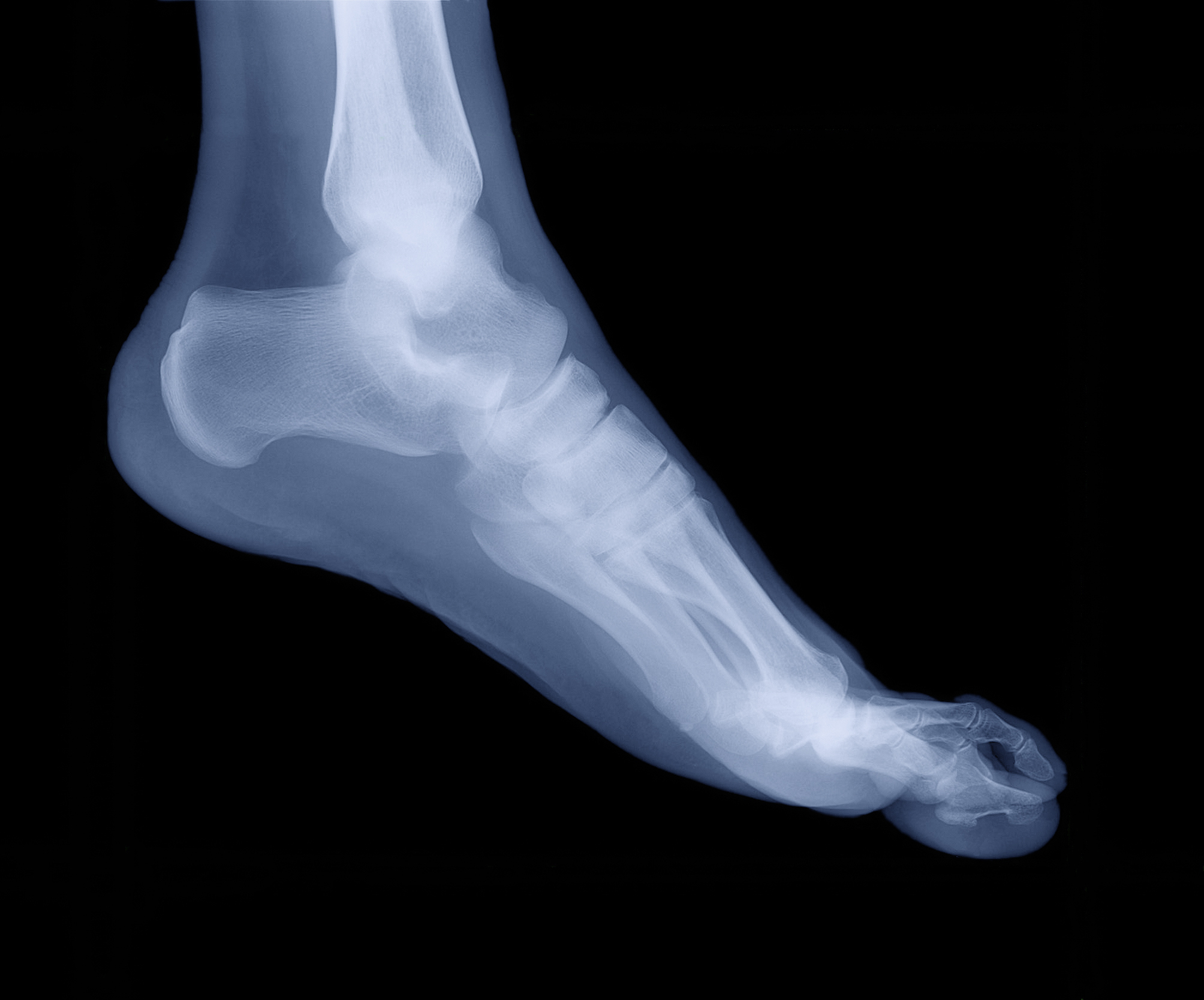 X-ray of a human foot