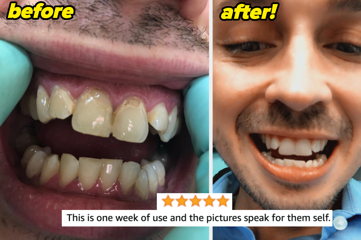 a reviewer&#x27;s before and after, after using the Waterpik for a week