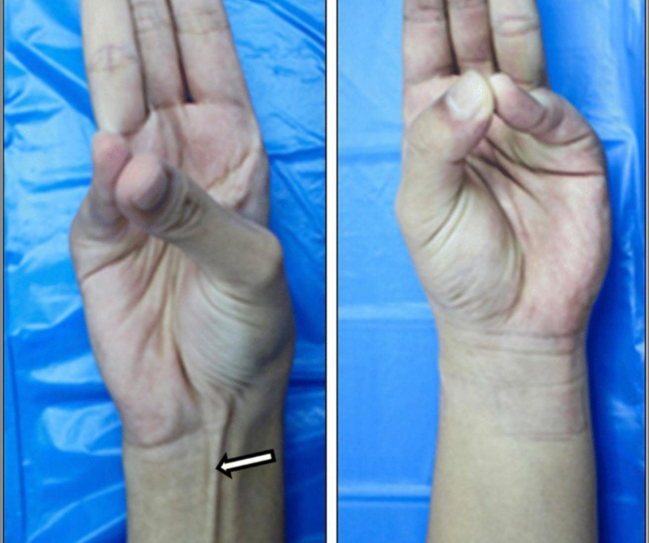 A hand with and without a palmaris longus muscle